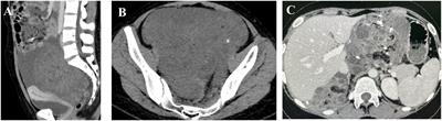 Growing teratoma syndrome of the ovary: a case report and literature review